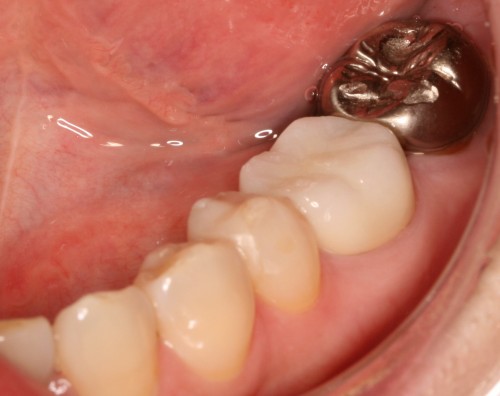 オールセラミッククラウン　左下６（自費）　と　銀歯　左下７（保険）